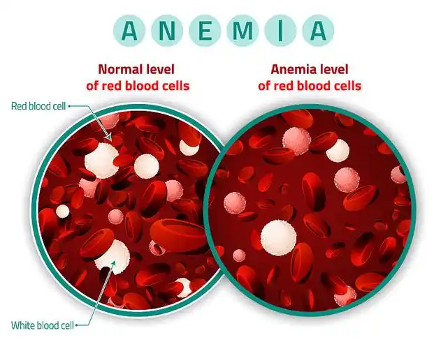 贫血血细胞水平图片