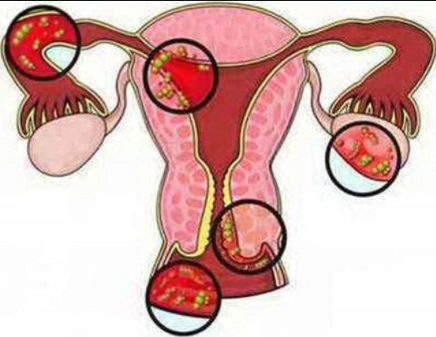 盆腔炎疾病科普