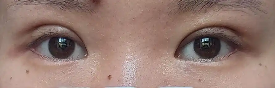 线结反应有小白包 多长时间能消下去呀