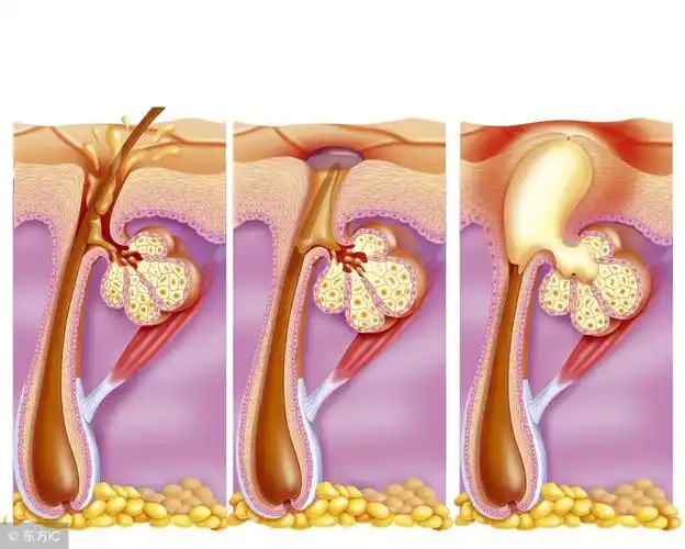 毛孔堵塞怎么清理你的毛孔也堵塞了吗有什么方法可以打通被堵塞的毛孔