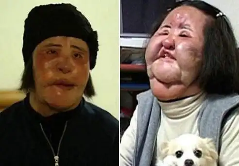 韩国女网红赵秀珍就在社交平台自曝自己整容过度失败,差点儿毁容