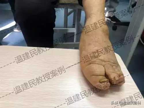 听说过"象皮腿"吗?