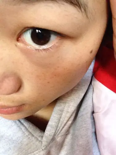 我想知道我这眼睛是眼袋还是浮肿 偶尔大点偶尔小点 肿了有半年了 我