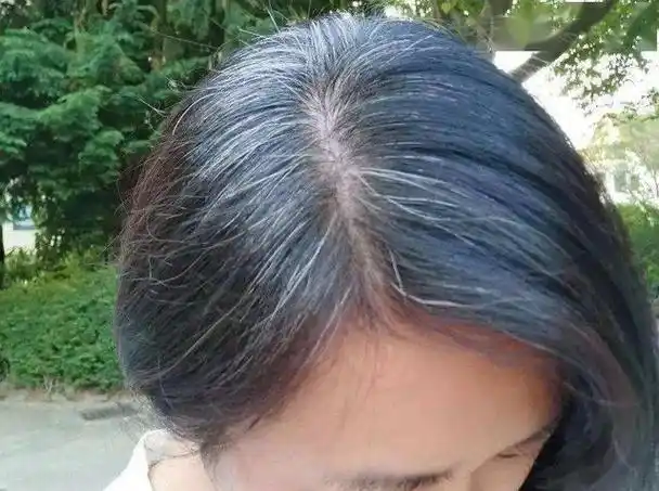 女性头上白发增多,别总认为老了,可能是体内缺乏这几种营养元素