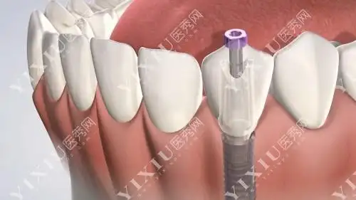 种植牙安装图