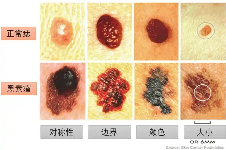 滴呜足底有痣需警惕