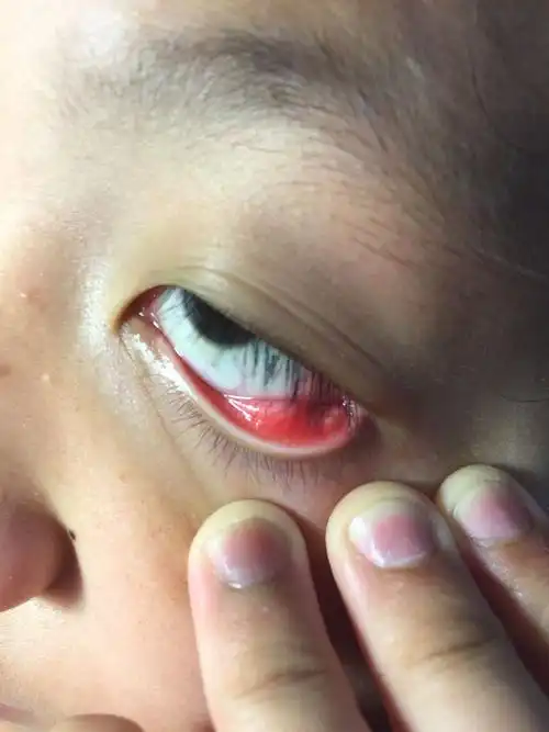 孩子眼睛疼,看见下眼皮里有包,什么病?用什么药?