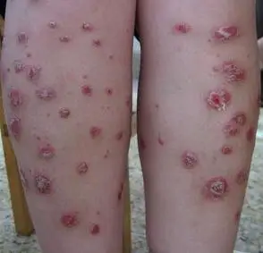 点滴牛皮癣症状有哪些_常识_疾病常识_牛皮癣银屑病_慢性病健康网