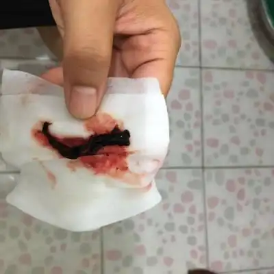 怀孕整40天突然出血流出一个血块,然后就乾净了,想知道这是什麼情况?