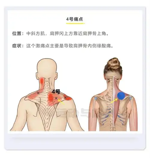 如何快速定位斜方肌的激痛点,这6张图片请收好!