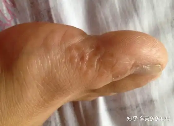 水泡型脚气的水泡,不要用针挑破,会扩散和加重.