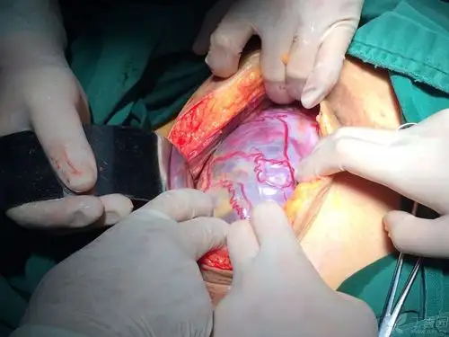 凶险性前置胎盘并胎盘植入图片 [病例帖]