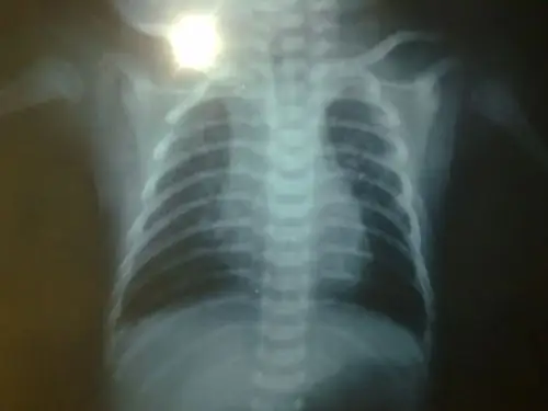 优美孕!新生儿支气管肺炎"涕泪横流"-第2张图片-光口博客