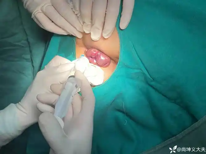 环状混合痔外剥内扎术