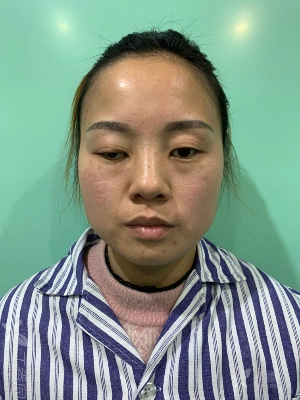 【讨论】重度上睑下垂矫正术