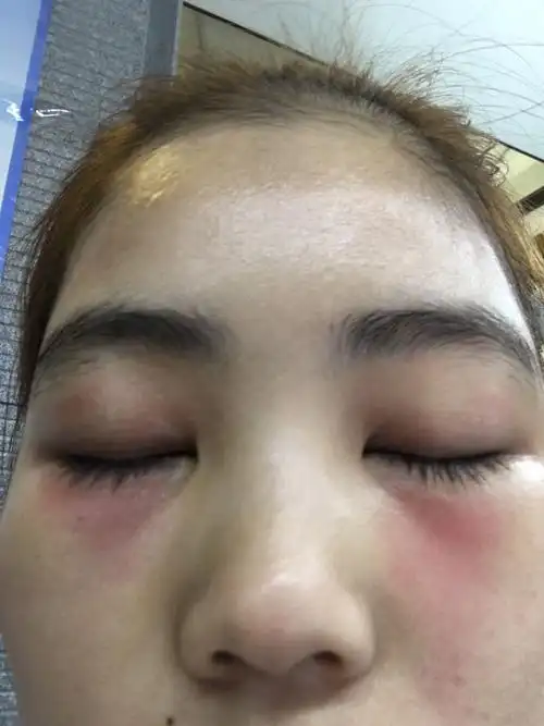 用地奈德软膏搭配红霉素眼膏,可以吗?