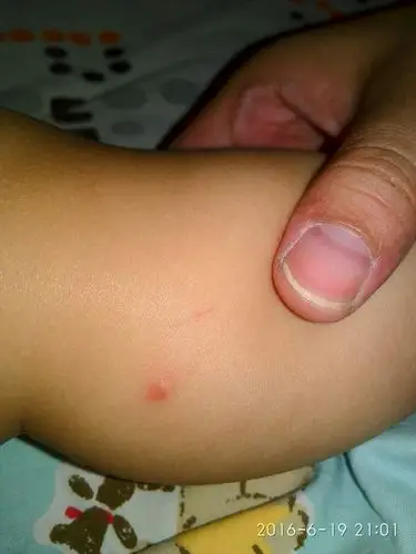 九朵妈    2016-06-19 21:02    浏览  33333  推荐回答 考虑毛囊炎的