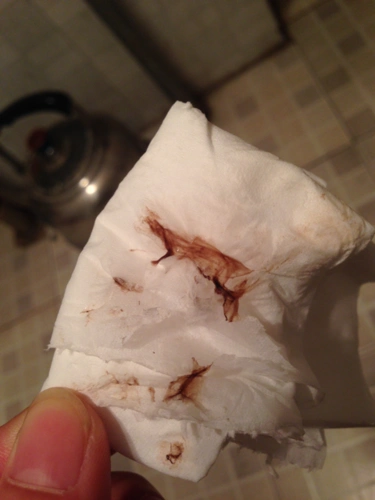 为什么已经排卵了还会白带拉丝呢?还是暗红色的?