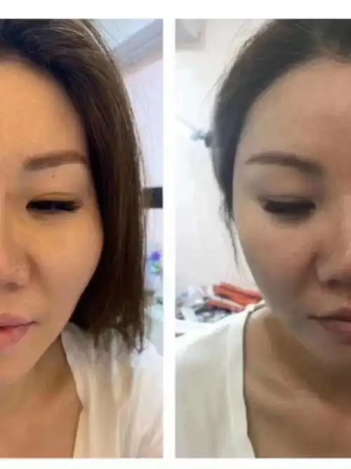 太阳穴泪沟填充对比