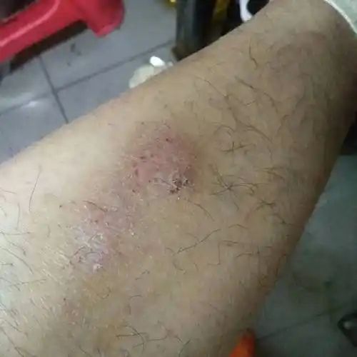 用什么药可以治愈. 就这一块,是不是长了什么癣?