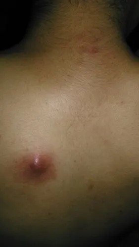 背上起了个小红疙瘩,挤了以后出血水,过了几天变大了如图片,有人说是