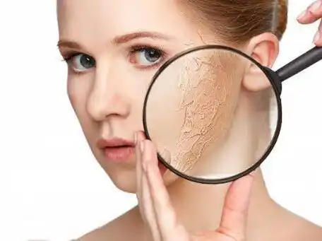 冬天寒风吹的脸局部干燥脱皮该怎么办