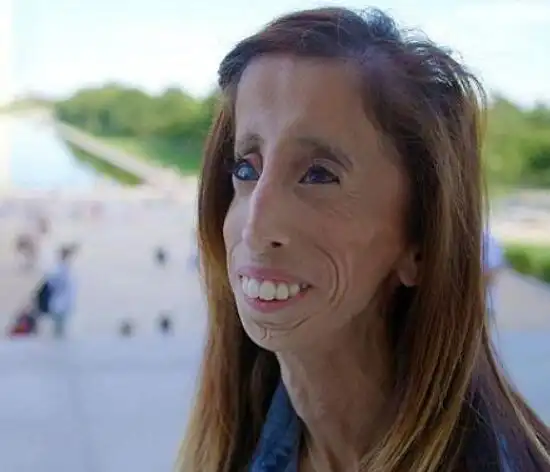 世界上最丑女人,丽兹·维拉斯奎兹(先天畸形/人虽丑但很励志)