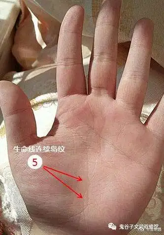 身体有癌症病兆的人其手纹特征