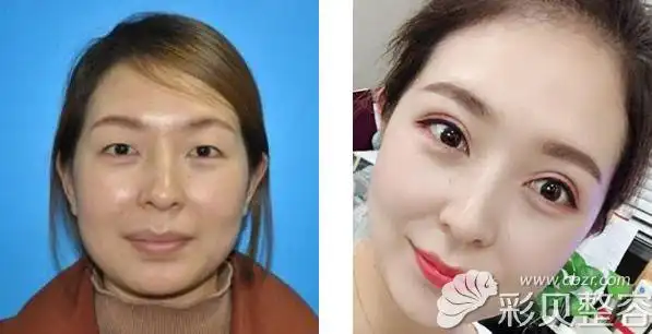 兰州亚韩谢雯割双眼皮 自体脂肪面部填充前后效果对比图