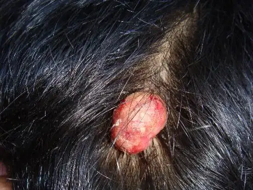 女儿头发表面长了个肉瘤在后脑处哪里,不痛不痒,不知是什么瘤