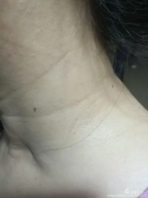 颈部丝状疣