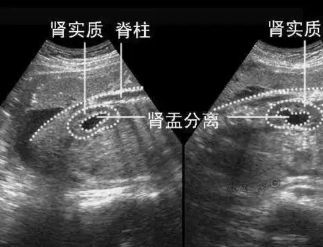 快拿出b超上的照片,教你怎么自己看孩子性别,大夫也是这样判断_胎儿