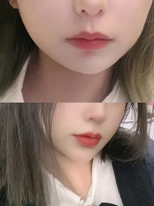 还是喜欢嘴巴嘟嘟的,这样显得可爱,看过很多案例_圈子-新氧美容整形