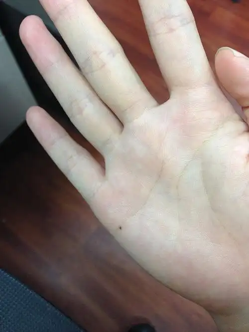 手心有痣还是后来才长的,是提示我真命天子出现了么