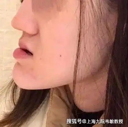 九院韦敏教授丨不同类型的地包天应如何矫正