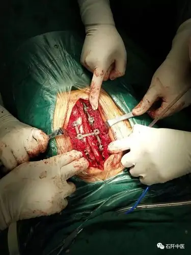 关爱无限以实际行动助力脱贫攻坚战石阡县中医医院成功治疗首例多发上