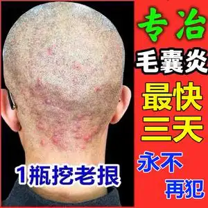 治疗头皮毛囊炎神器全身背手臂痘痘膏去鸡皮肤疙瘩毛囊堵塞角质药