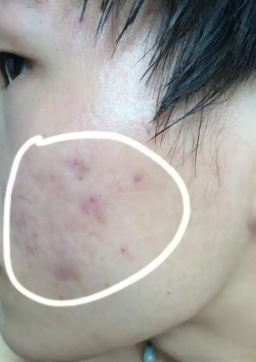 工作期间经常熬夜或者通宵,脸上两边就开始长青春痘了《如照片》,其