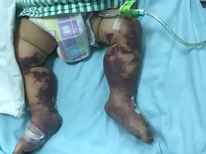 严重脓毒症dic至双下肢瘀斑