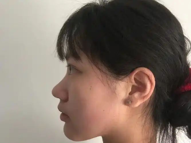 我的鼻型是那种正面瞧鼻翼肥大,侧面看鼻梁低不够挺96_圈子-新氧