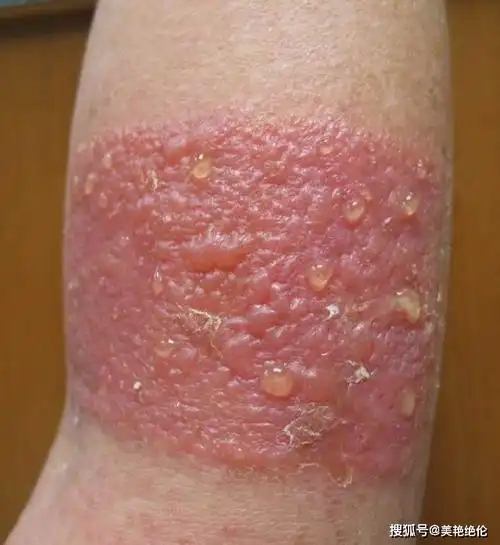 颜次方小知识膏药贴久了皮肤受损怎能办