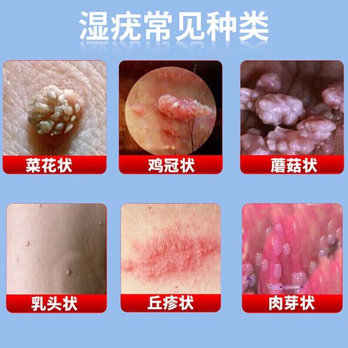 嘧啶软膏氟尿软膏扁平疣丝状疣瘊猴子肉粒去1疣灵疣必治hpv干扰素乳膏