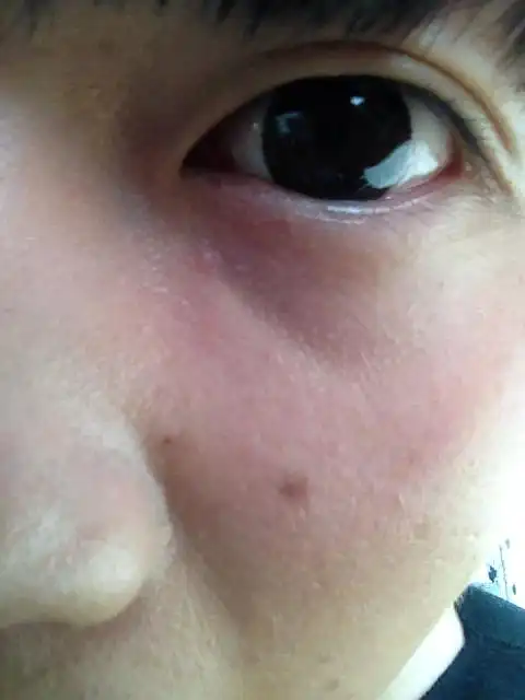 我眼睛下面长了个疙瘩,我也不知道是平常的痘痘还是其他,求大家帮忙看