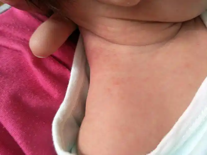 湿疹初期小红点照片『床上螨虫咬的症状图片』