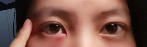 腿毛们我眼睛肿了一个包 好疼.