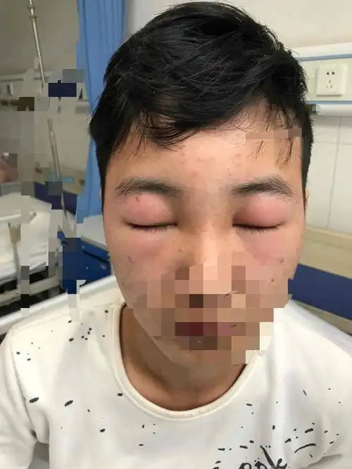 不到20岁的男孩,来的时候浮肿,眼睛都睁不开眼睛,腿也肿的像个萝卜,有