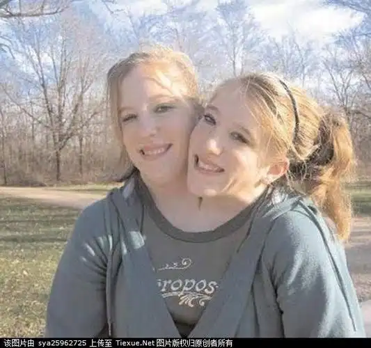 奇异的连体双胞胎