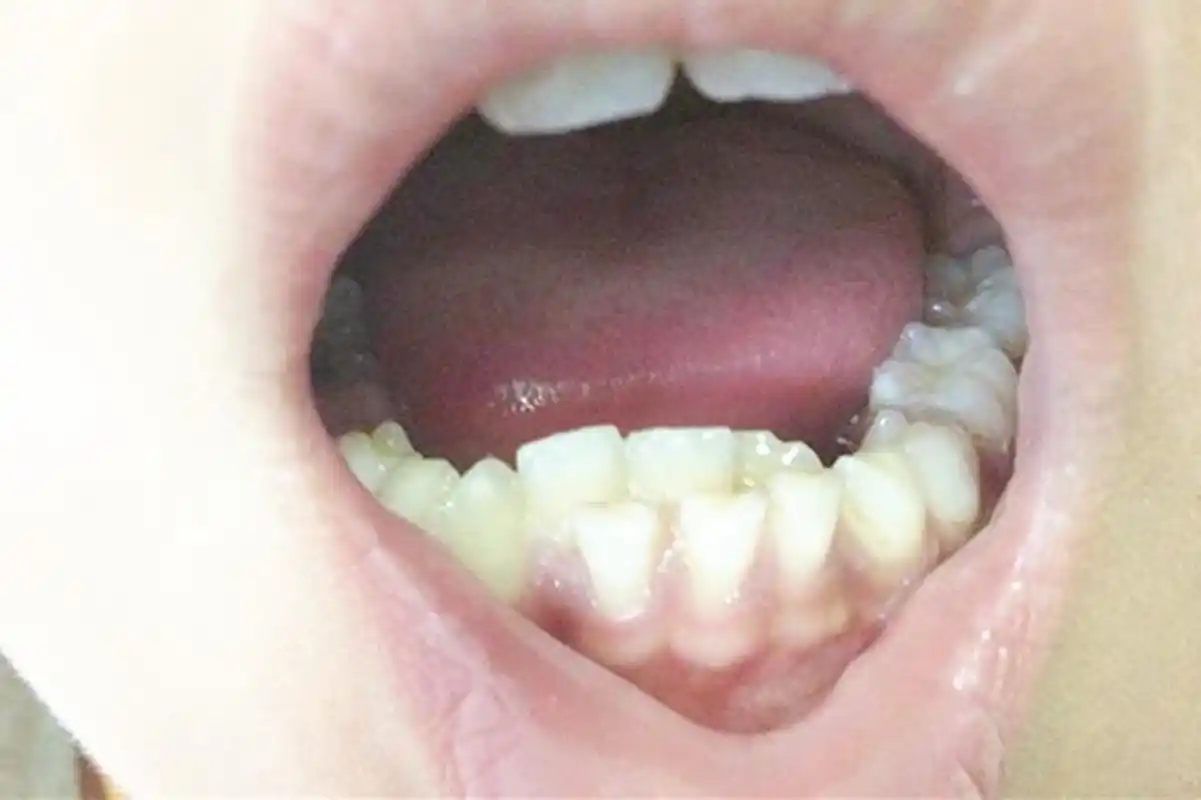 7岁孩子长出双排牙,都因奶奶有这个坏习惯,很多家长都要反思