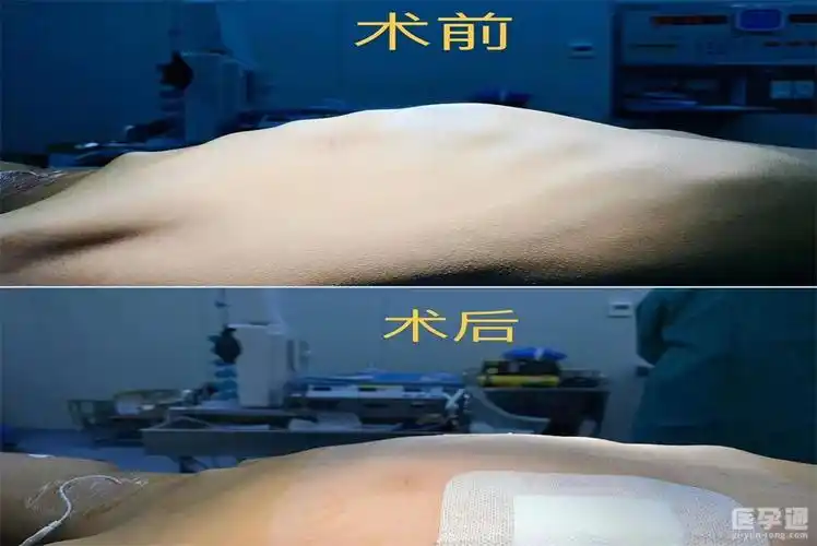 小儿鸡胸和正常人区别图片对比,图文识别早发现早干预 - 医孕通