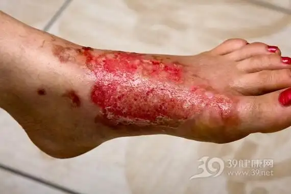 烫伤后的水疱不可挑破-第1张图片